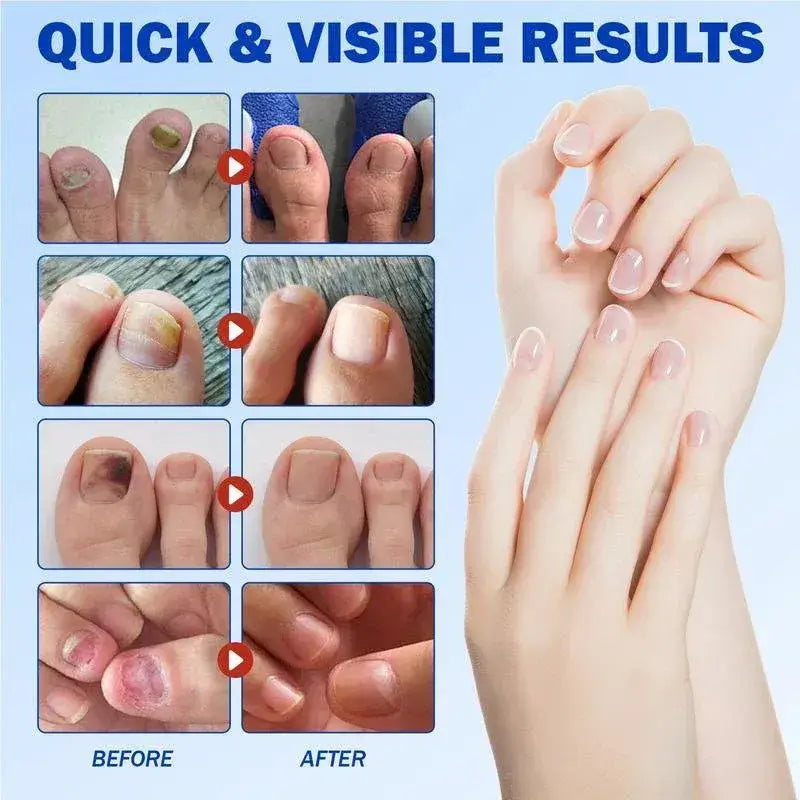 A promotional graphic with the headline 'QUICK & VISIBLE RESULTS' above a grid of before-and-after toenail photos on the left and a pair of hands with neatly manicured nails on the right, all on a light blue background.