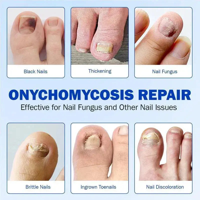 FungGone™ - Nail Repair Patches